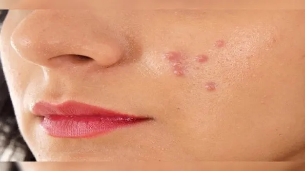 మొటిమలకు ఎలక్ట్రిక్‌ ప్యాచ్‌..