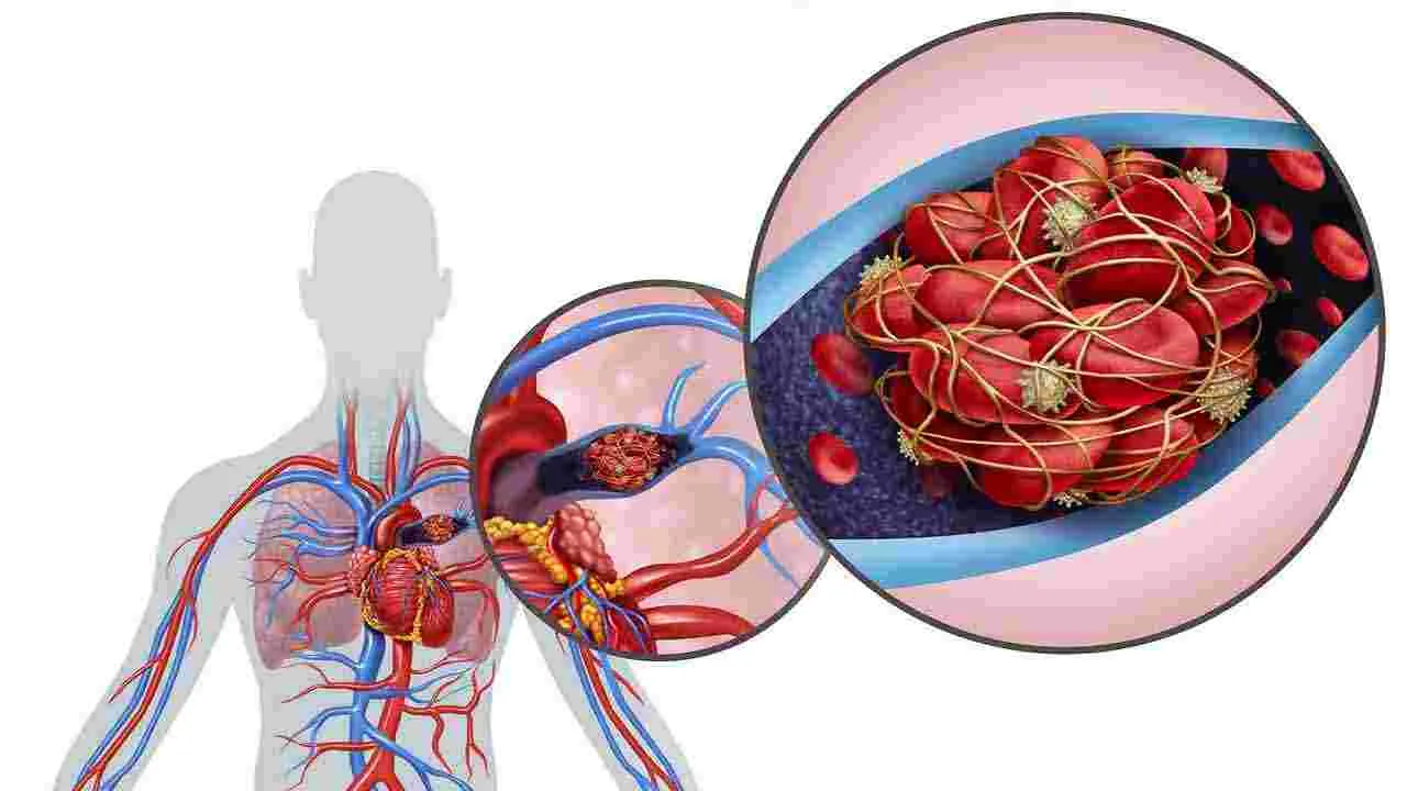 Bad Cholesterol: చెడు కొలెస్ట్రాల్ వదిలించుకోవడానికి 5 సింపుల్ చిట్కాలు..