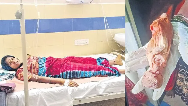 Hanumkonda: కడుపులో దూది పెట్టి కుట్లు వేసిన డాక్టర్‌