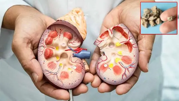 Kidney Stones: ఈ మొక్కతో కిడ్నీలో రాళ్లు కరిగిపోవాల్సిందే