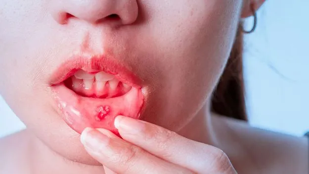 Mouth Ulcer Tips: ఈ చిట్కాలతో.. ఒక్క పూటలోనే నోటి పూత సమస్య పరార్..