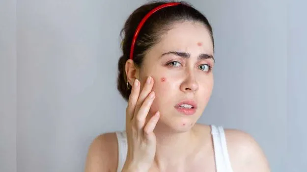 Skincare Tips: వేసవిలో మొటిమలు పెరిగిపోతున్నాయా.. ఈ సింపుల్ టిప్స్తో మచ్చలేని చర్మం..