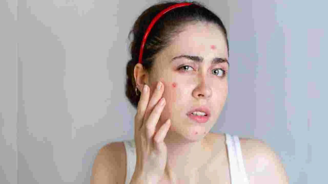 Skincare Tips: వేసవిలో మొటిమలు పెరిగిపోతున్నాయా.. ఈ సింపుల్ టిప్స్‌తో మచ్చలేని చర్మం..