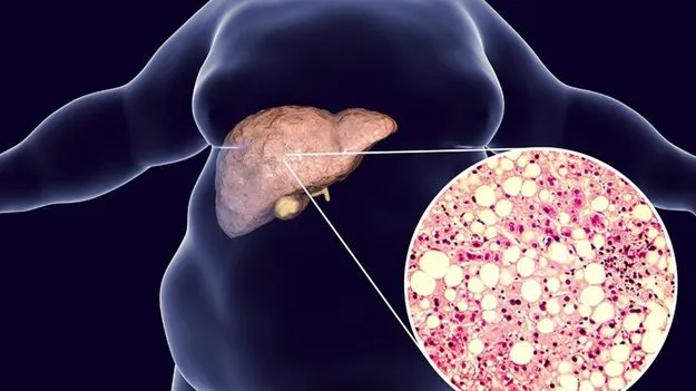 Fatty Liver Diease: ఫ్యాటీ లివర్‌తో బాధపడే వారు తప్పక తినాల్సిన ఫుడ్స్ ఇవే