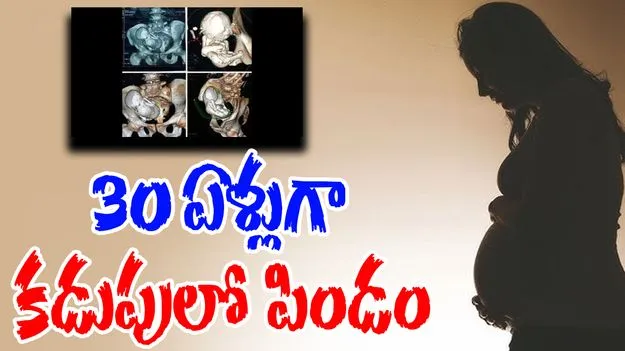 Calcified Fetus: 73 ఏళ్ల బామ్మ కడుపులో.. 30 ఏళ్ల పిండం
