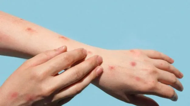 Chikungunya Symptoms: చికెన్గున్యా.. ఈ లక్షణాలు ఉంటే తక్షణమే జాగ్రత్త పడండి.!
