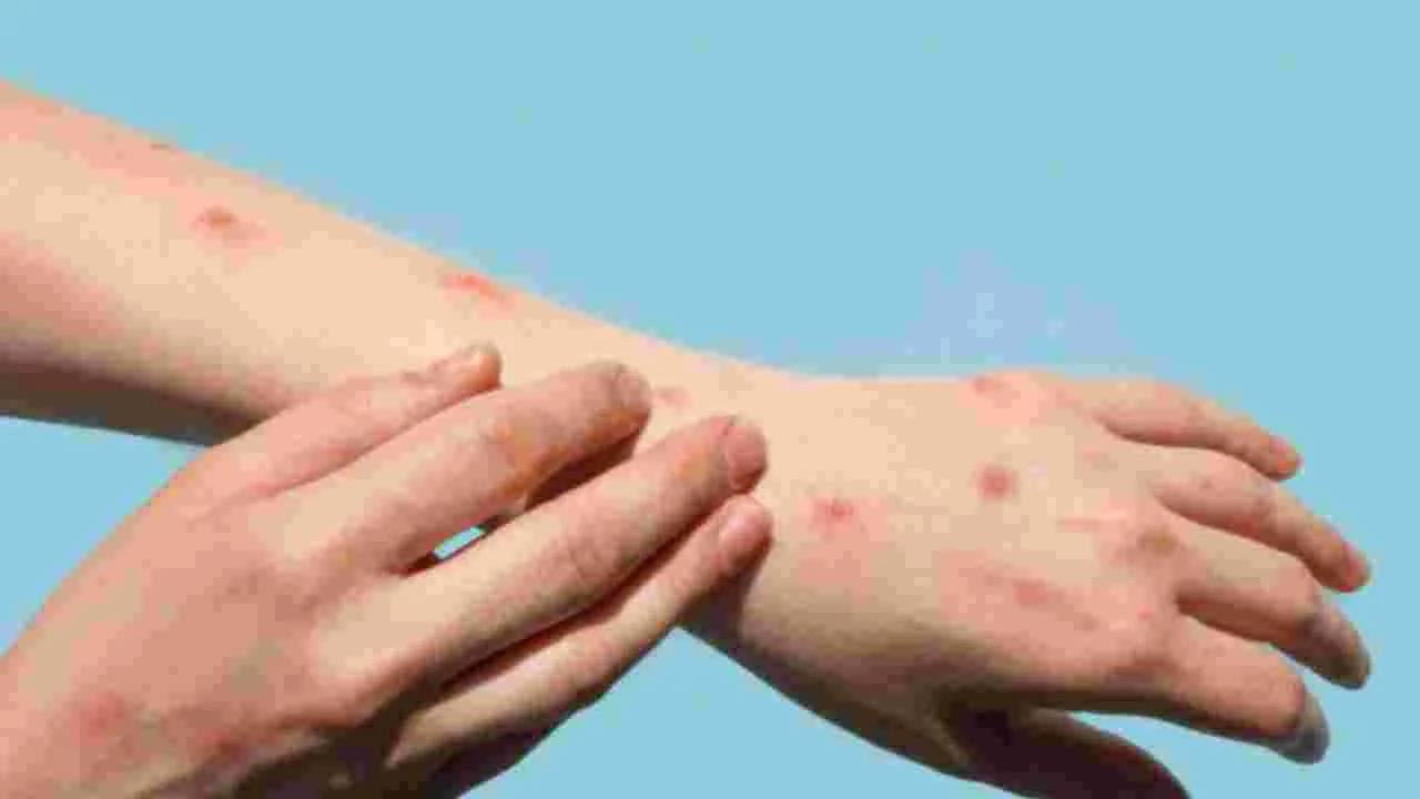 Chikungunya Symptoms:  చికెన్‌గున్యా.. ఈ లక్షణాలు ఉంటే తక్షణమే జాగ్రత్త పడండి.!