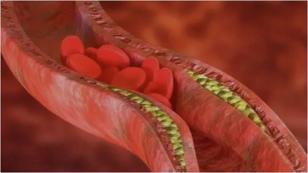 Symptoms of High Cholesterol:  ఈ లక్షణాలు ఉంటే జాగ్రత్త.. లేదంటే ఇక అంతే..!