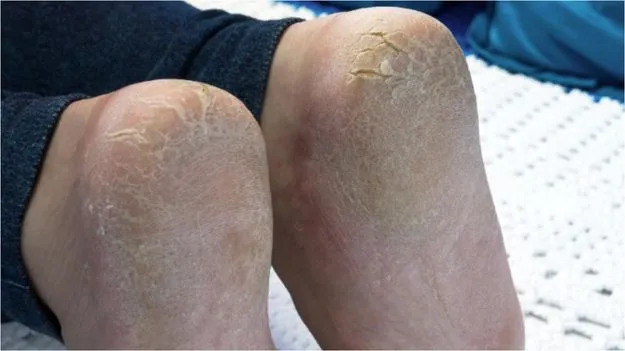 Cracked Heel Remedy:  మడమల పగుళ్లతో ఇబ్బంది పడుతున్నారా? ఈ నివారణలను ట్రై చేస్తే పగుళ్లు మాయం.!