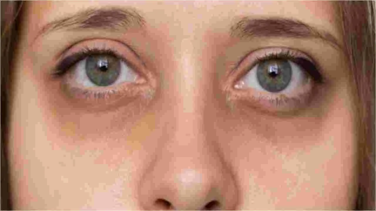 Beauty Tips: కళ్ల కింద నల్లగా ఉందా.. ఈ సహజ చిట్కాలు మీకోసమే..