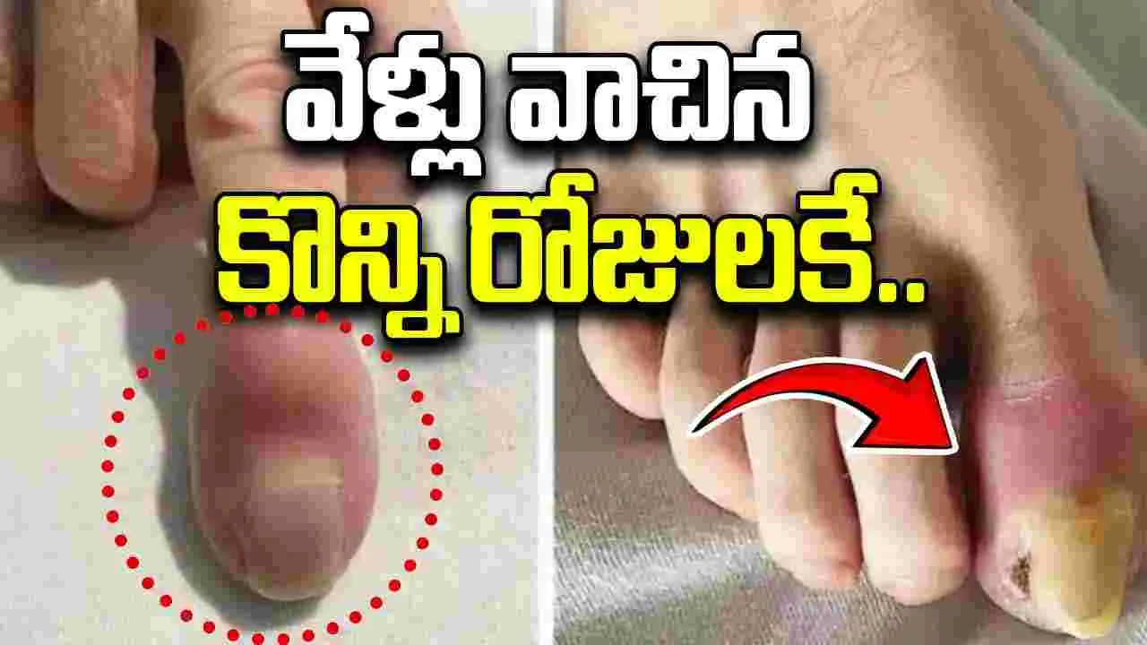 Acrometastasis Case: చేతి,కాలి వేళ్లు వాచాయి.. సరిగ్గా రెండు నెలల్లోనే.. 