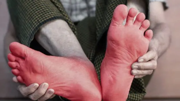 Foot Inflammation: అరికాళ్ళలో మంటగా అనిపిస్తుందా.. ఈ విషయాలు తెలుసుకోండి..