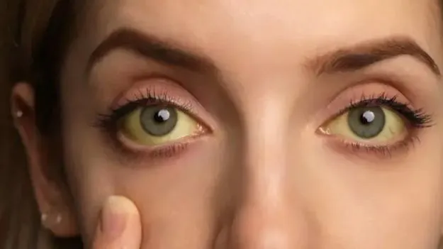 Jaundice Symptoms:  కళ్ళు, గోర్లు పసుపు రంగులోకి ఎందుకు మారతాయో తెలుసా.. 