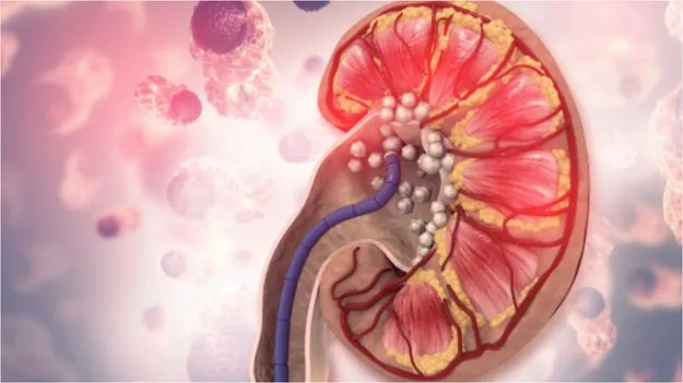 Natural Remedies For Kidney Stone:  ఆపరేషన్ అవసరం లేదు.. ఈ 7 ఆయుర్వేద పానీయాలతో కిడ్నీలో రాళ్లకు చెక్.. 