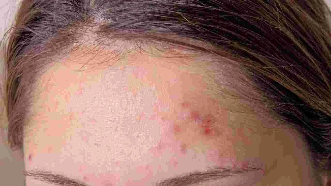 Pimples Tips: రాత్రిపూట ఈ పేస్ట్ రాస్తే పింపుల్స్, బ్లాక్ హెడ్స్ పోతాయ్..