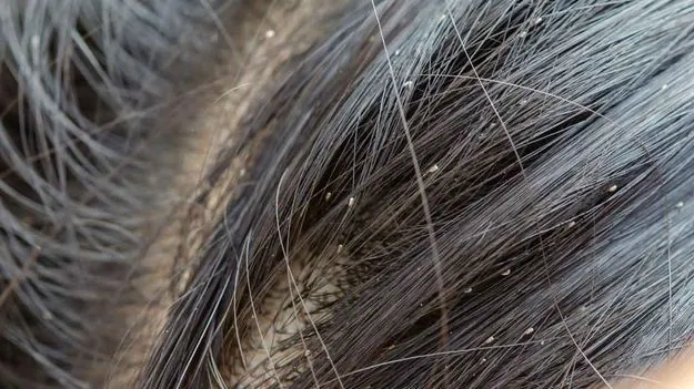 Home Remedies for Lice: తలలో పేలు ఇబ్బందిపెడుతున్నాయా? ఈ సింపుల్ చిట్కాలతో వెంటనే రిలీఫ్..!