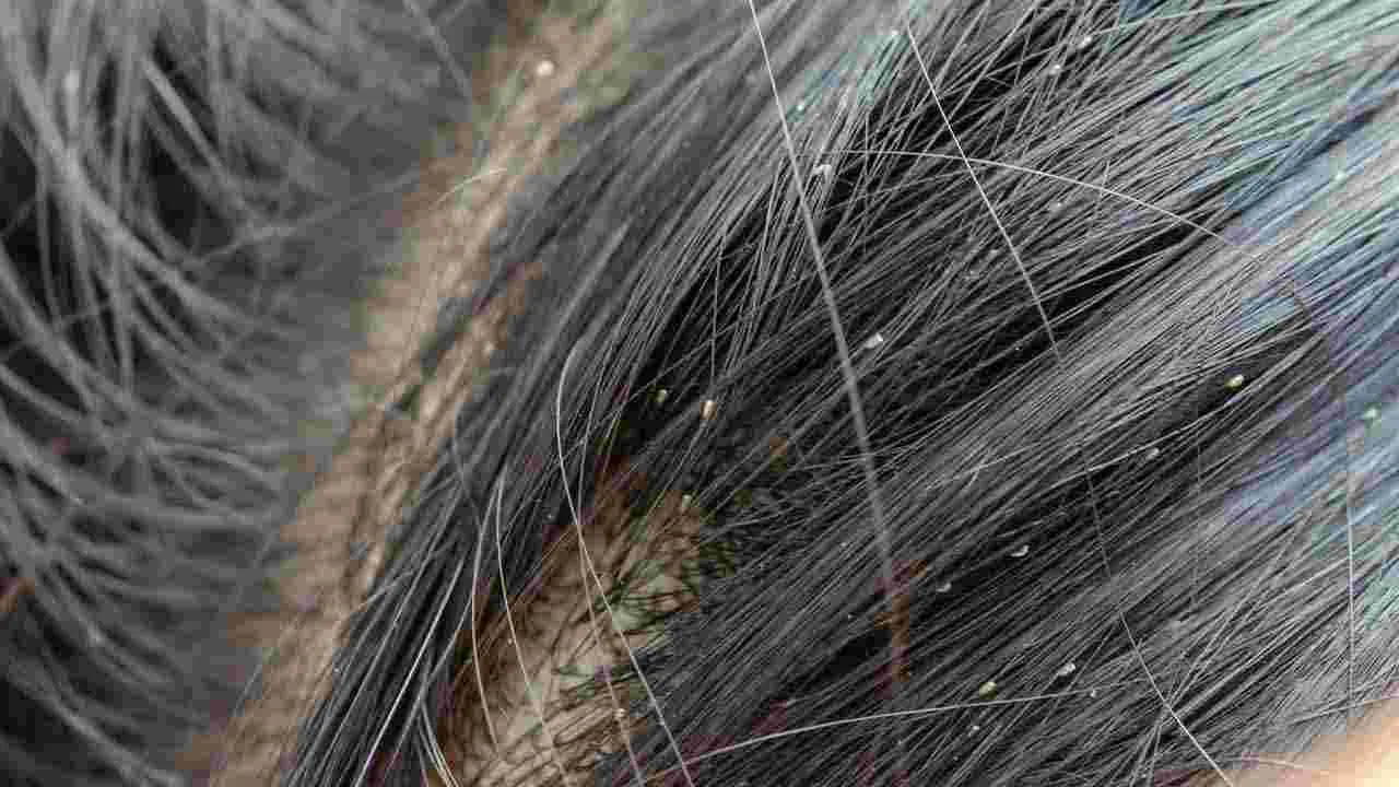 Home Remedies for Lice: తలలో పేలు ఇబ్బందిపెడుతున్నాయా? ఈ సింపుల్ చిట్కాలతో వెంటనే రిలీఫ్..!