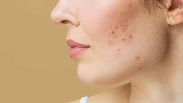 Skin Care Tips: వరసగా 7 రోజులు ఇలా చేస్తే.. పింపుల్స్ ఎప్పటికీ రావు..!