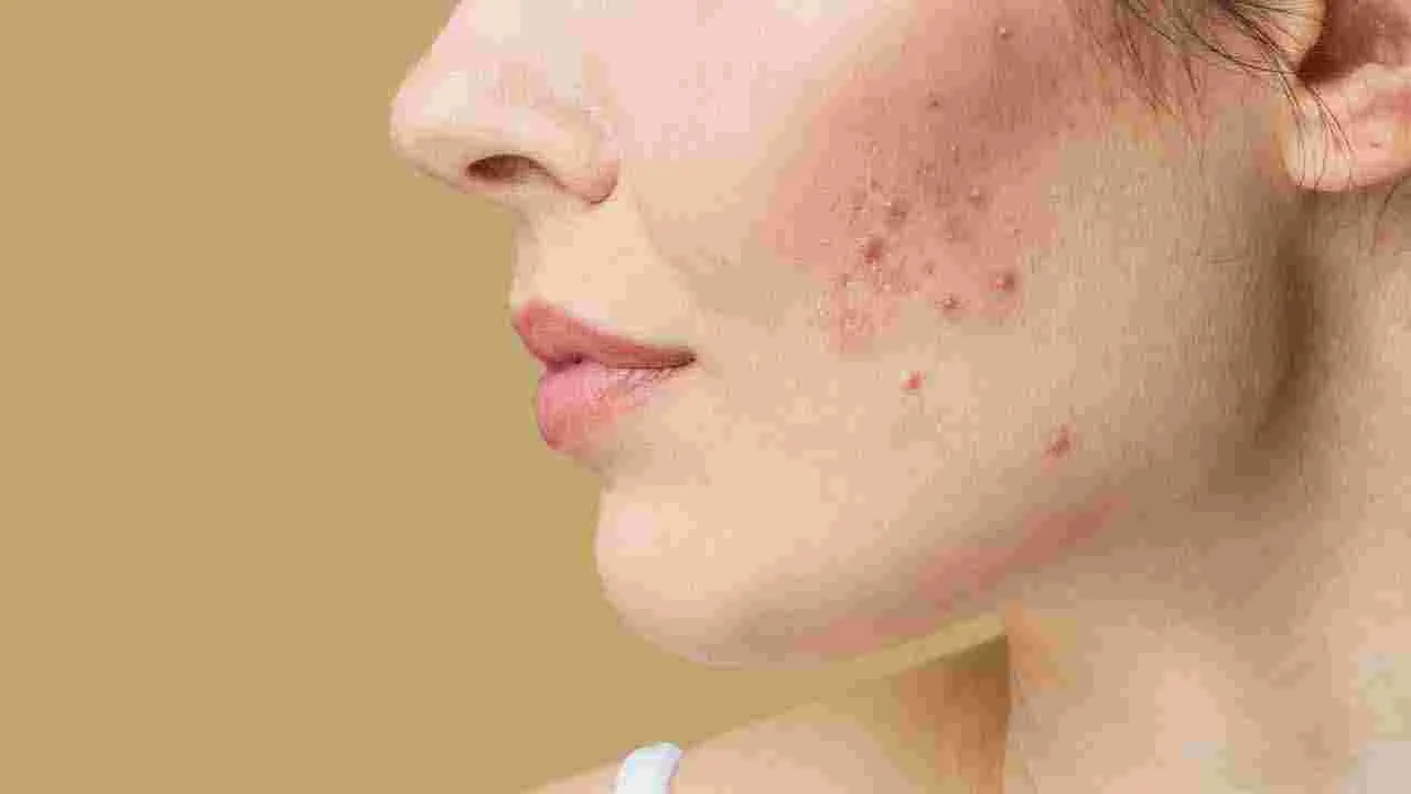 Skin Care Tips: వరసగా 7 రోజులు ఇలా చేస్తే.. పింపుల్స్ ఎప్పటికీ రావు..!