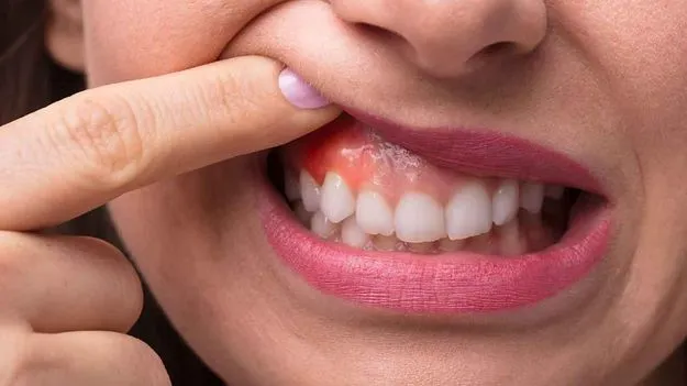 Swollen Gums: పళ్ల చిగుళ్లు ఎందుకు ఉబ్బుతాయి? నివారణకు ఏం చేయాలి?