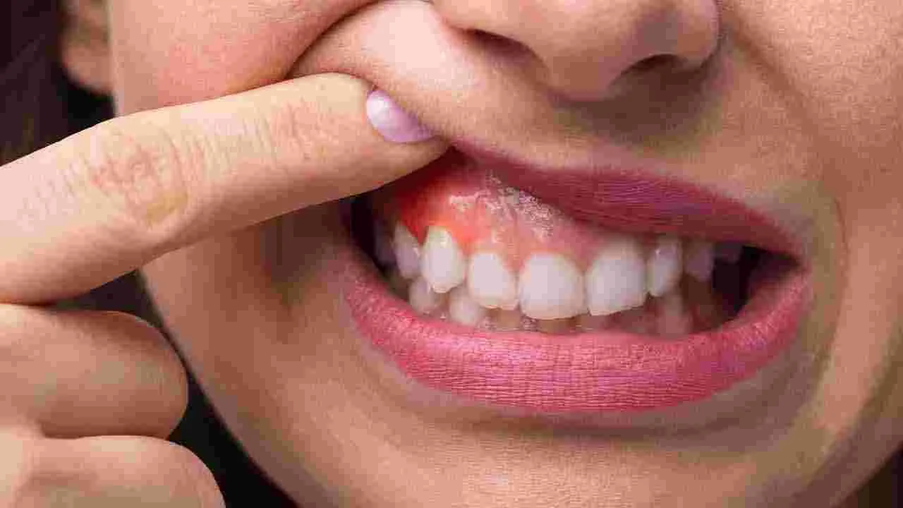Swollen Gums: పళ్ల చిగుళ్లు ఎందుకు ఉబ్బుతాయి? నివారణకు ఏం చేయాలి?