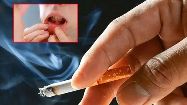 Mouth Cancer: ముఖంలో కనిపించే ఈ చిన్న మార్పే... నోటి క్యాన్సర్కు సంకేతమా?