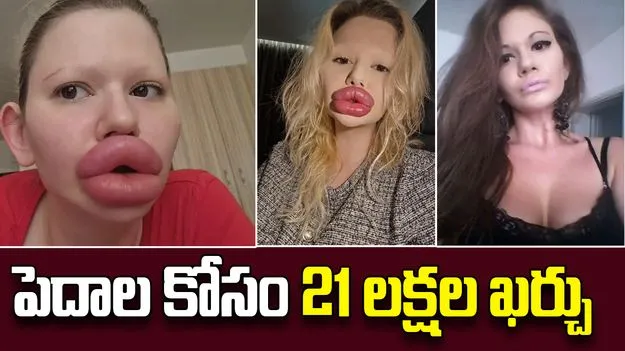 Worlds Largest Lips: యువతి పిచ్చి పీక్స్.. పెదాలకోసం 21 లక్షలు ఖర్చు పెట్టింది..