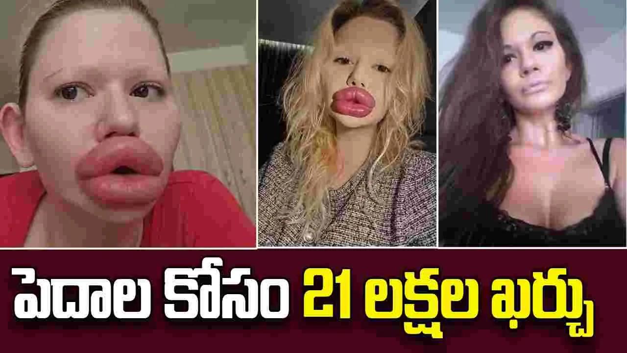 Worlds Largest Lips: యువతి పిచ్చి పీక్స్.. పెదాలకోసం 21 లక్షలు ఖర్చు పెట్టింది..