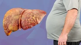 Fatty Liver-Cancer Risk: ఫ్యాటీ లివర్ ఉన్న వాళ్లకు క్యాన్సర్ ముప్పు.. ఈ తప్పులు అస్సలు చేయొద్దు