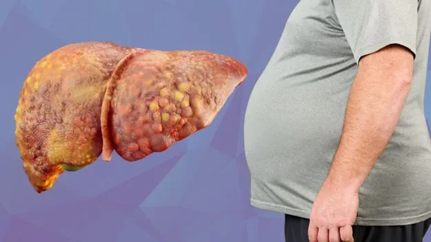Fatty Liver-Cancer Risk: ఫ్యాటీ లివర్ ఉన్న వాళ్లకు క్యాన్సర్ ముప్పు.. ఈ తప్పులు అస్సలు చేయొద్దు