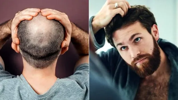 Hair Transplant Scam: జుట్టు మొలిపిస్తామని.. ముంచేశారు