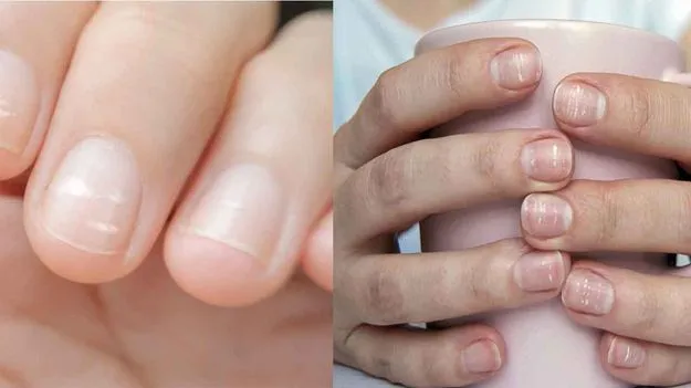 Nail Color Changes: గోళ్ల రంగు మారిందా? ఈ 7 జబ్బులకు సిగ్నల్ కావొచ్చు!