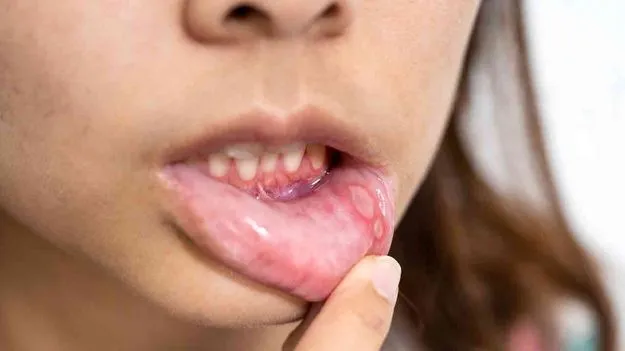 Mouth Ulcer Remedies: నోటి పూత తగ్గేదెలా