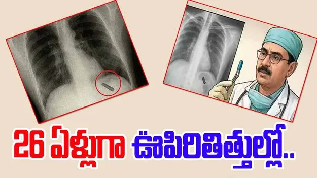 Pen Cap Stuck In Lung: అత్యంత అరుదైన సంఘటన.. 26 ఏళ్లుగా వ్యక్తి ఊపిరితిత్తుల్లో పెన్ క్యాప్