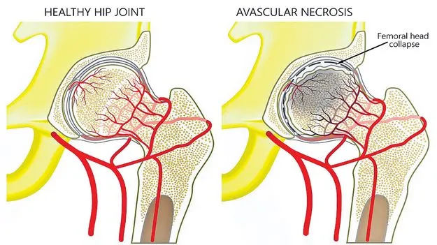 పిన్న వయసులోనే అవాస్కులర్‌ నెక్రోసిస్‌