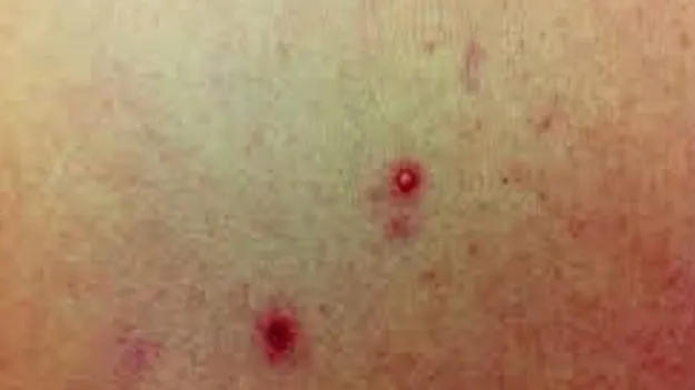 Melioidosis Fever: అవి మెలియోయిడోసిస్‌ జ్వరాలే..