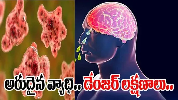 Brain Infection: కొత్తగా వెలుగులోకి అరుదైన బ్రెయిన్ వ్యాధి..ఇప్పటికే ముగ్గురు మృతి