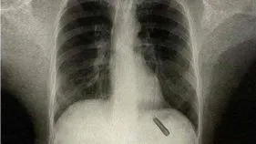 Pen Cap Stuck In Lung: అత్యంత అరుదైన సంఘటన.. 26 ఏళ్లుగా వ్యక్తి ఊపిరితిత్తుల్లో పెన్ క్యాప్