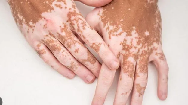 White Spots On Skin: చర్మంపై తెల్లని మచ్చలు ఎందుకు వస్తాయి.. ఇది ఒక వ్యాధినా?