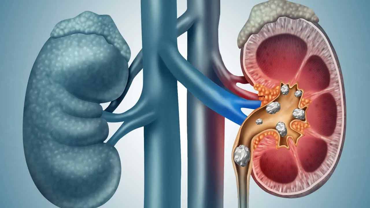 kidney Stones: కిడ్నీలో రాళ్లు ఉన్నాయా..? అయితే ఇవి తినండి.. 