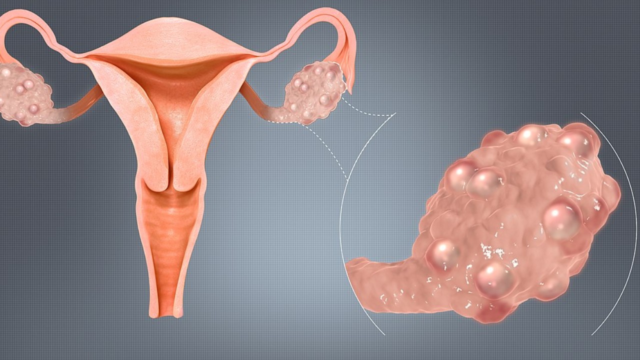 PCOS: పీసీఓఎస్ ఉన్న వారు తప్పక తెలుసుకోవాల్సిన విషయాలు