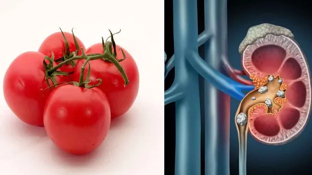 Tomato Side Effects: కిడ్నీలో రాళ్లు రావడానికి టమాటాలు కారణమా..?