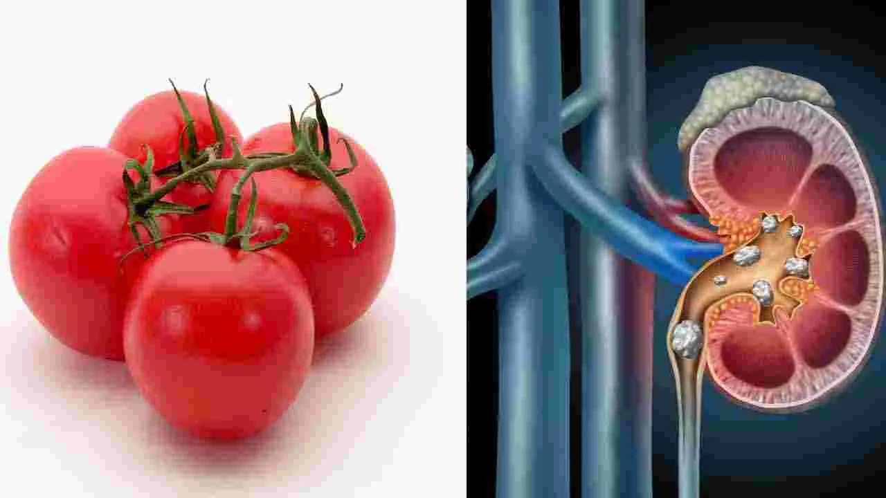 Tomato Side Effects: కిడ్నీలో రాళ్లు రావడానికి టమాటాలు కారణమా..?