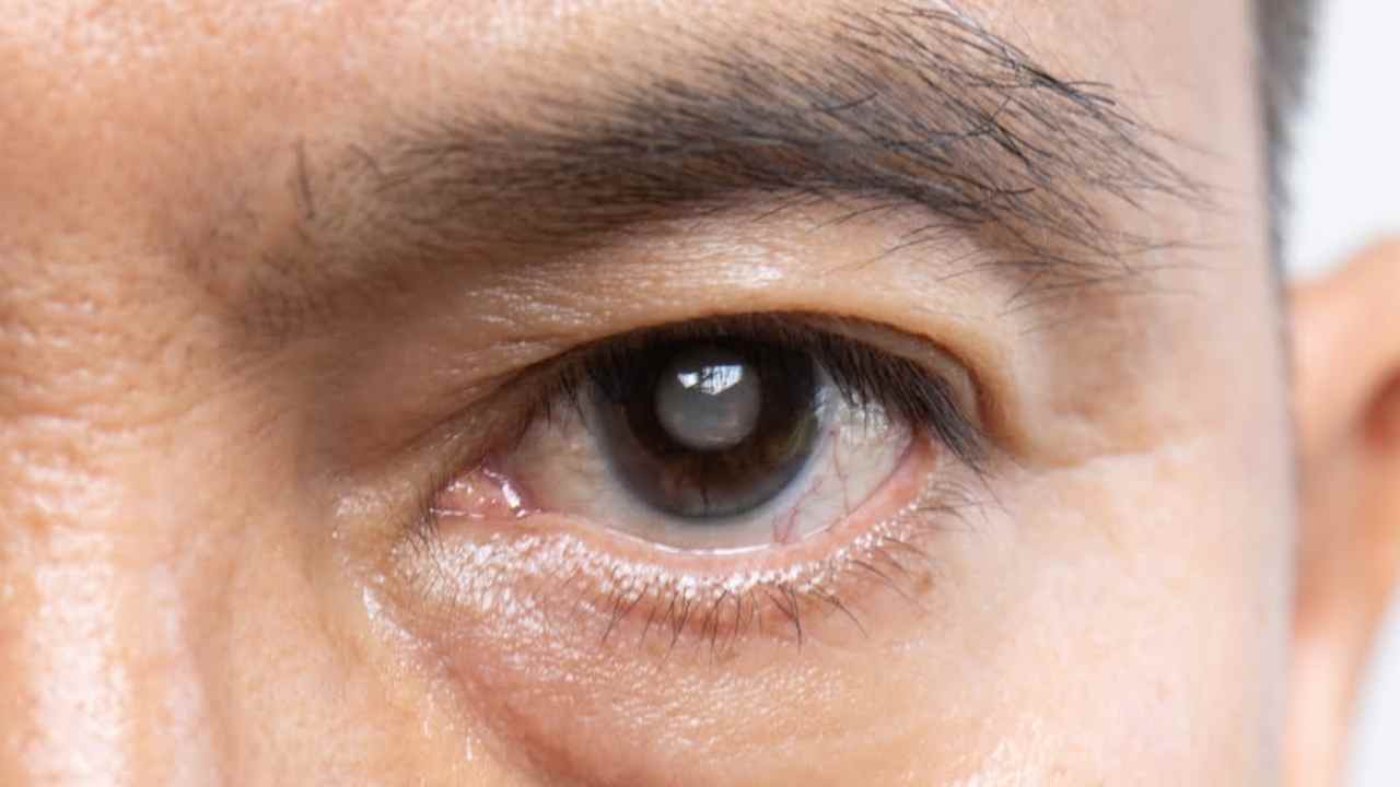 Cataract: వయసు పెరుగుతోందా? క్యాటరాక్ట్ ముప్పును తగ్గించుకోవాలంటే.. 