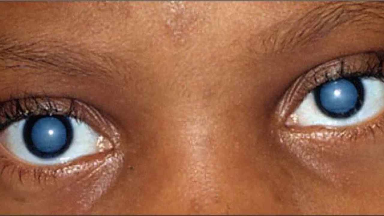 Cataract: వయసు పెరుగుతోందా? క్యాటరాక్ట్ ముప్పును తగ్గించుకోవాలంటే.. 