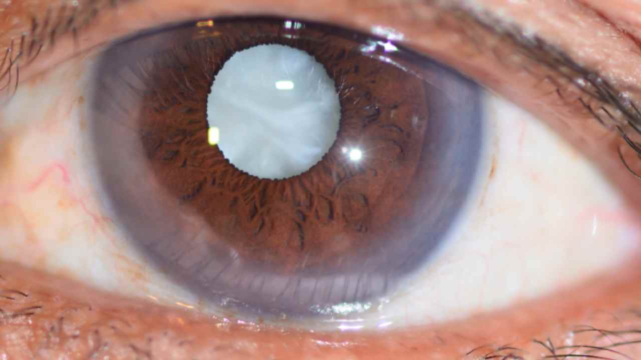 Cataract: వయసు పెరుగుతోందా? క్యాటరాక్ట్ ముప్పును తగ్గించుకోవాలంటే.. 