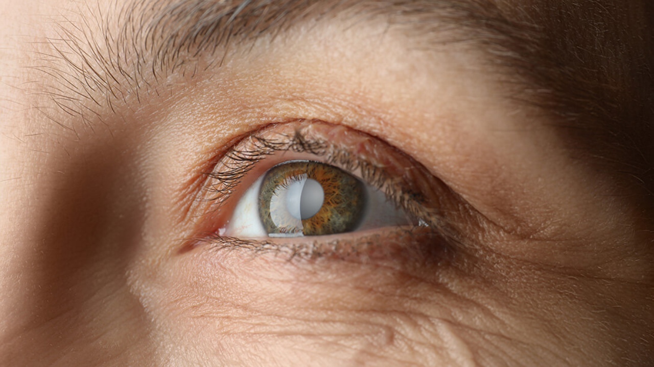 Cataract: వయసు పెరుగుతోందా? క్యాటరాక్ట్ ముప్పును తగ్గించుకోవాలంటే.. 
