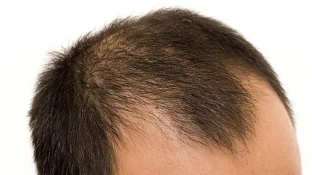 Baldness Causes: చుండ్రుతో బట్టతల? క్లారిటీ ఇచ్చిన ప్రముఖ వైద్యుడు