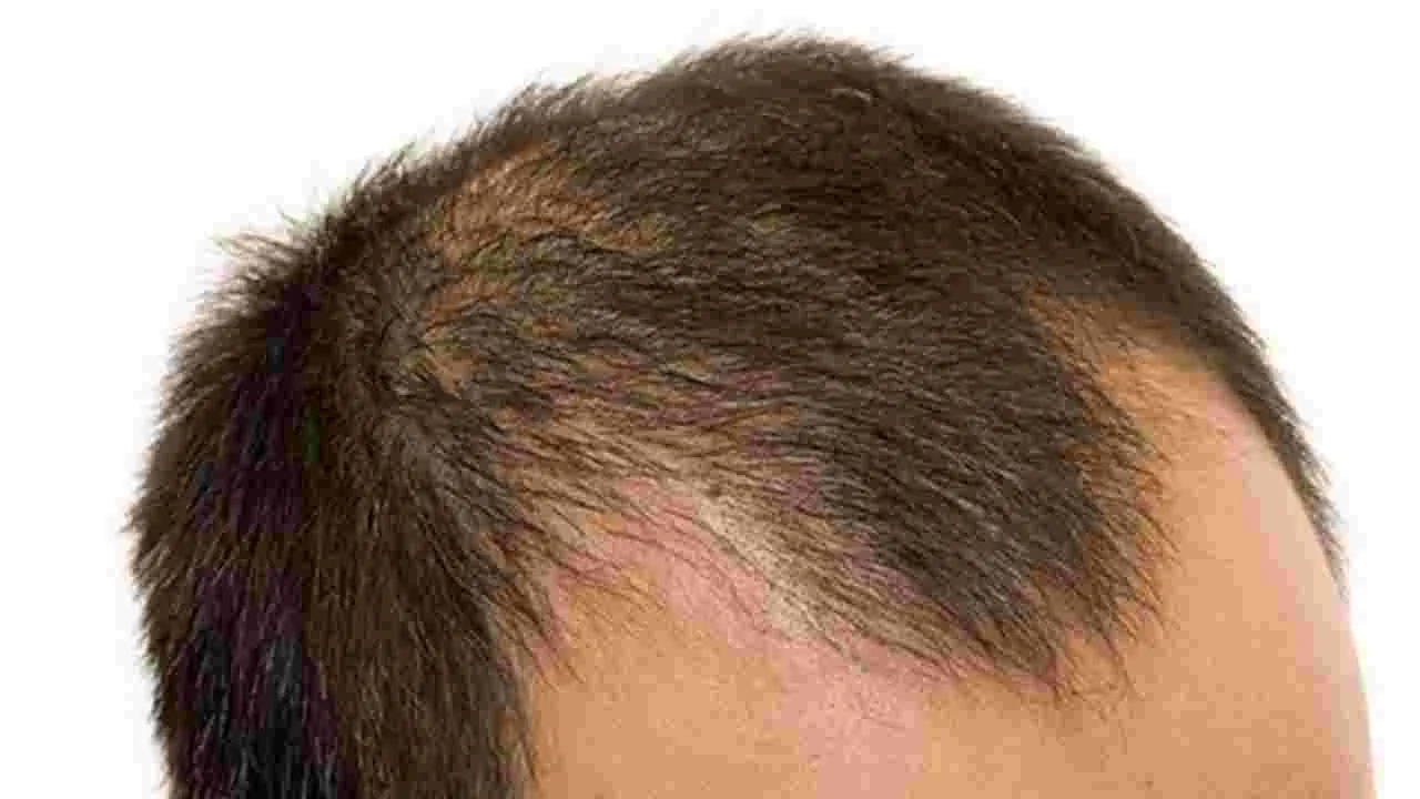 Baldness Causes: చుండ్రుతో బట్టతల? క్లారిటీ ఇచ్చిన ప్రముఖ వైద్యుడు