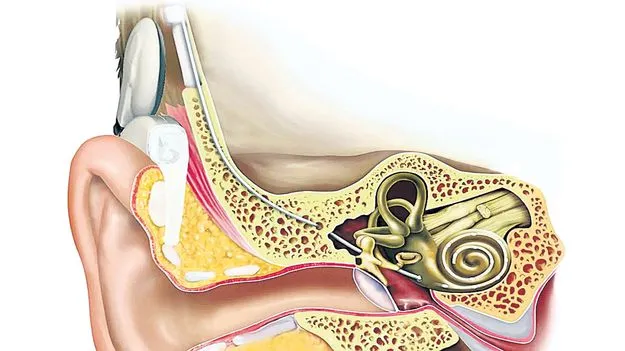 నిలిచిన కాక్లియర్‌ ఇంప్లాంట్‌ సర్జరీలు!